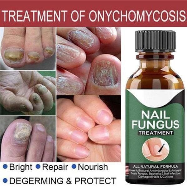 •Fast Nail Fungal Treatments Nail Repair
•  Quickly Penetrates And Kills