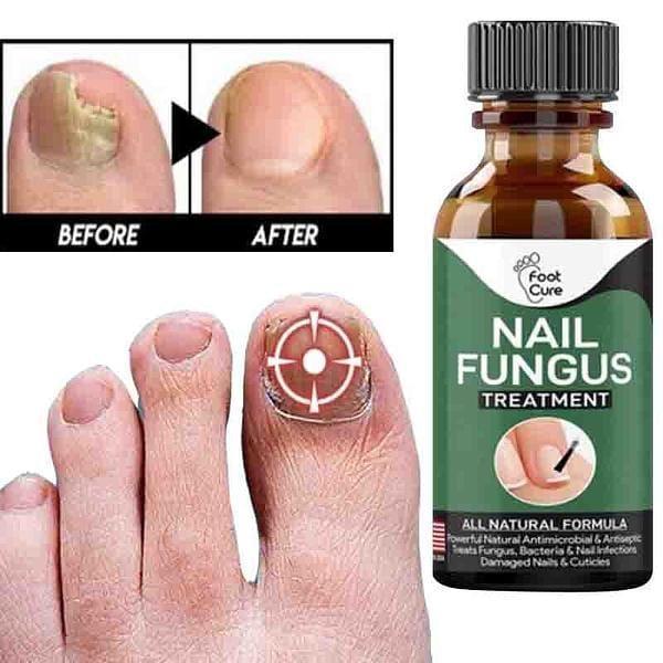 •Fast Nail Fungal Treatments Nail Repair
•  Quickly Penetrates And Kills