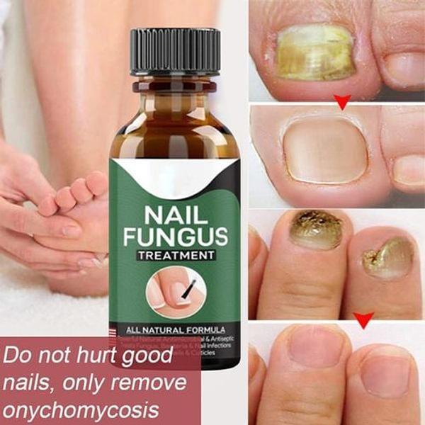 •Fast Nail Fungal Treatments Nail Repair
•  Quickly Penetrates And Kills